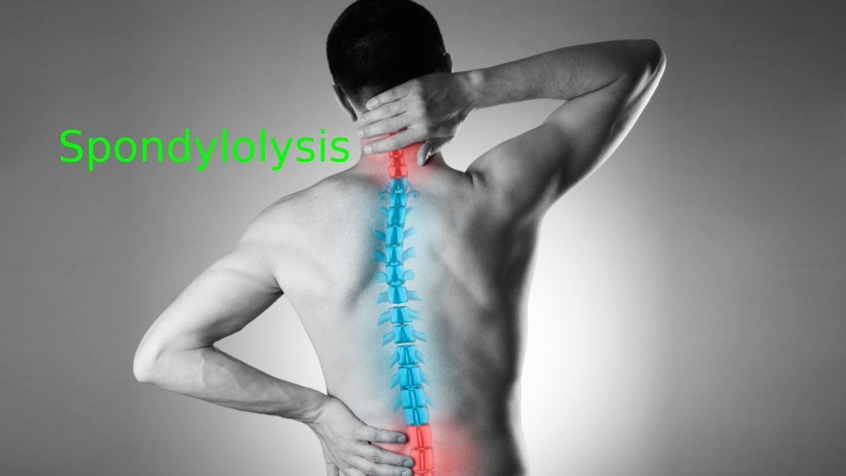 What Is Spondylolysis? – Causes, Symptoms, Treatment, And More