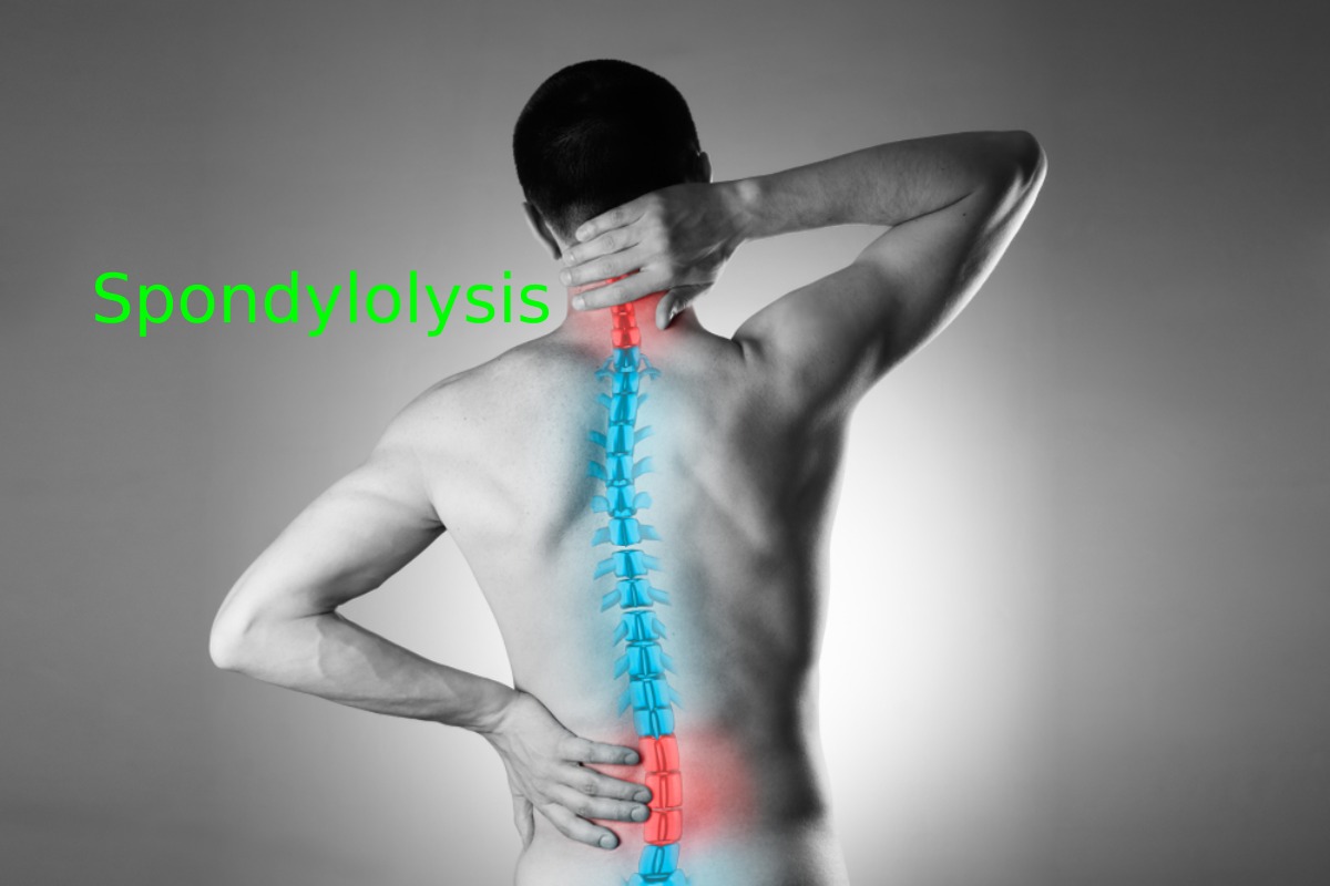 What Is Spondylolysis_ – Causes, Symptoms, Treatment, And More