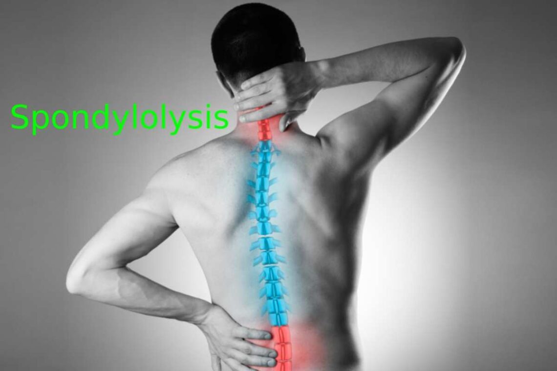 Spondylolysis
