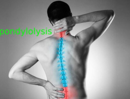 Spondylolysis